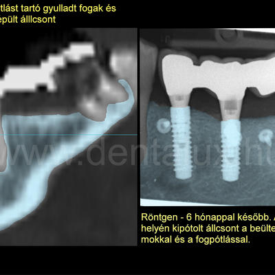 Dent-A-Lux - Fogbeültetés és csontpótlás. Akár foghúzás után –azonnal!
