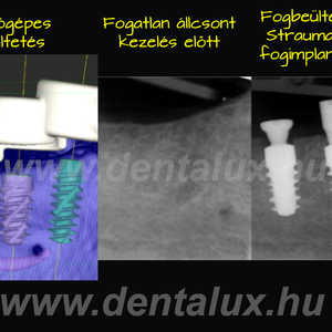 Dr. Kőhalmi Tamás fogorvos a Dent-A-Lux Fogászat-on Kecskeméten először végzett Magyarországon számítógéppel tervezett és vezérelt fogbeültetés-t Straumann BLX fogimplantátum-okkal. Így foghúzás után a fogbeültetés és a fogpótlás is azonnal elkészíthető! Fogorvos Kecskemét::Fogászat-Fogbeültetés-Csontpótlás-Kecskemét
