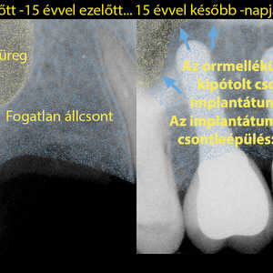 Cikkünk első részében a periimplantitiszről, a fogimplantátum(ok) körüli gyulladásról írtunk, ami akár a műgyökér és vele a fogpótlás elvesztését is okozhatja. Ez pedig sokba kerülhet... Mi a megoldás? Mindenekelőtt: a megelőzés -az egészségtudatosság. Mire érdemes figyelni? Erről szól a cikkünk 2. része. # fogimplantátum #fogbeültetés #fogorvos #fogászat #fogpótlás #csontpótlás #Kecskemét