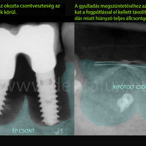 A periimplantitisz a fogimplantátum körüli gyulladás. Mindazoknak, akik fogbeültetés után vannak és implantációs fogpótlás van a szájukban azért jó ismerni, mert ez a gyulladás sokba kerülhet. Kezeletlenül akár az implantátumok és a fogpótlás elvesztését is okozhatja. Erről szól a cikkünk 1. része. # fogimplantátum #fogbeültetés #fogorvos #fogászat #fogpótlás #csontpótlás #Kecskemét